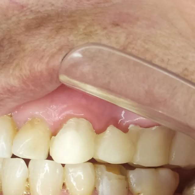 Prótesis dental fija de porcelana en el sector anterior