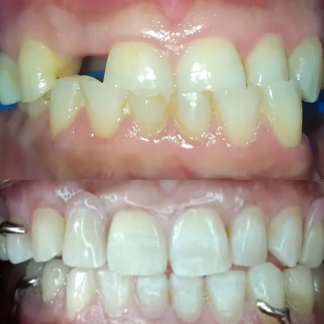 Antes: dientes desgastados, desalineados y con espacios